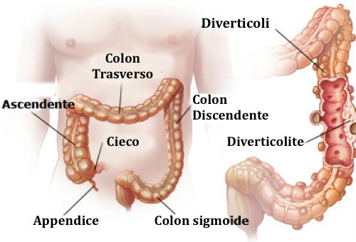 diverticolosi cosa è