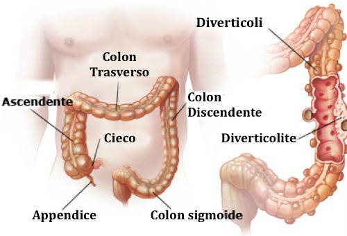 diverticolosi cosa è