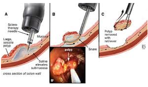 dissezione endoscopica sottomucosa