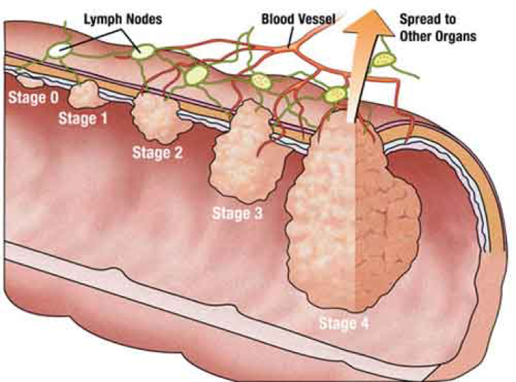 cancro al colon