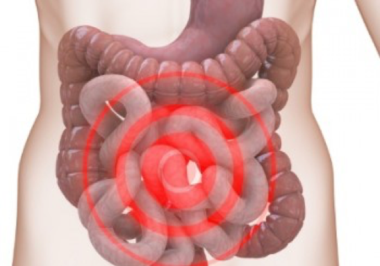 sindrome del colon irritabile