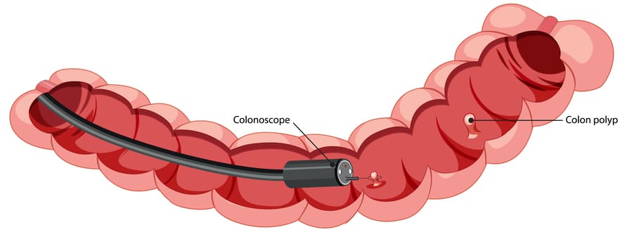 colonscopia per diagnosi tumore colon