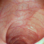 Colonscopia robotica diagnostica 1
