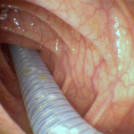 Colonscopia robotica diagnostica 2