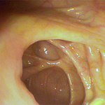 Colonscopia robotica diagnostica 3