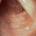 Colonscopia robotica diagnostica 4