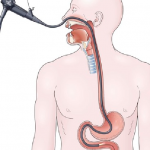 Colonscopia robotica con Colon Wash e gastroscopia transnasale nella stessa seduta