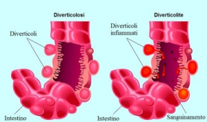 diverticoli cosa sono