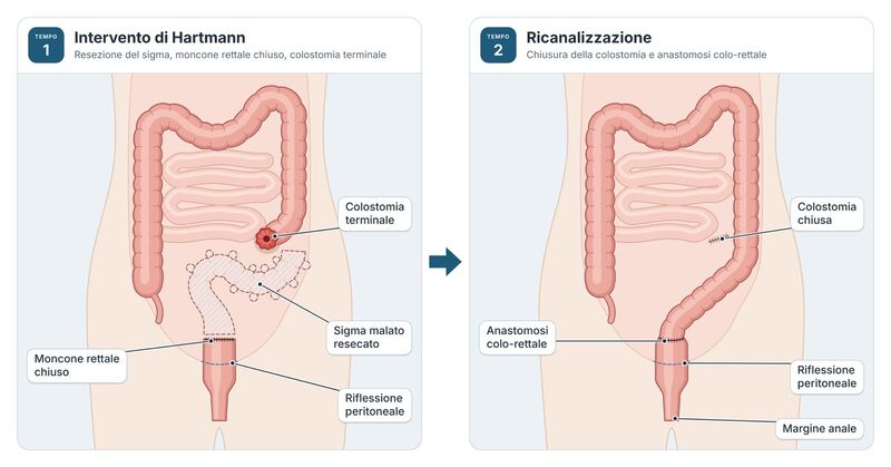 intervento di Hartmann