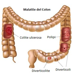 colite ulcerosa sintomi diagnosi cura