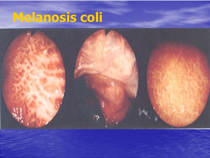 melanosi colon