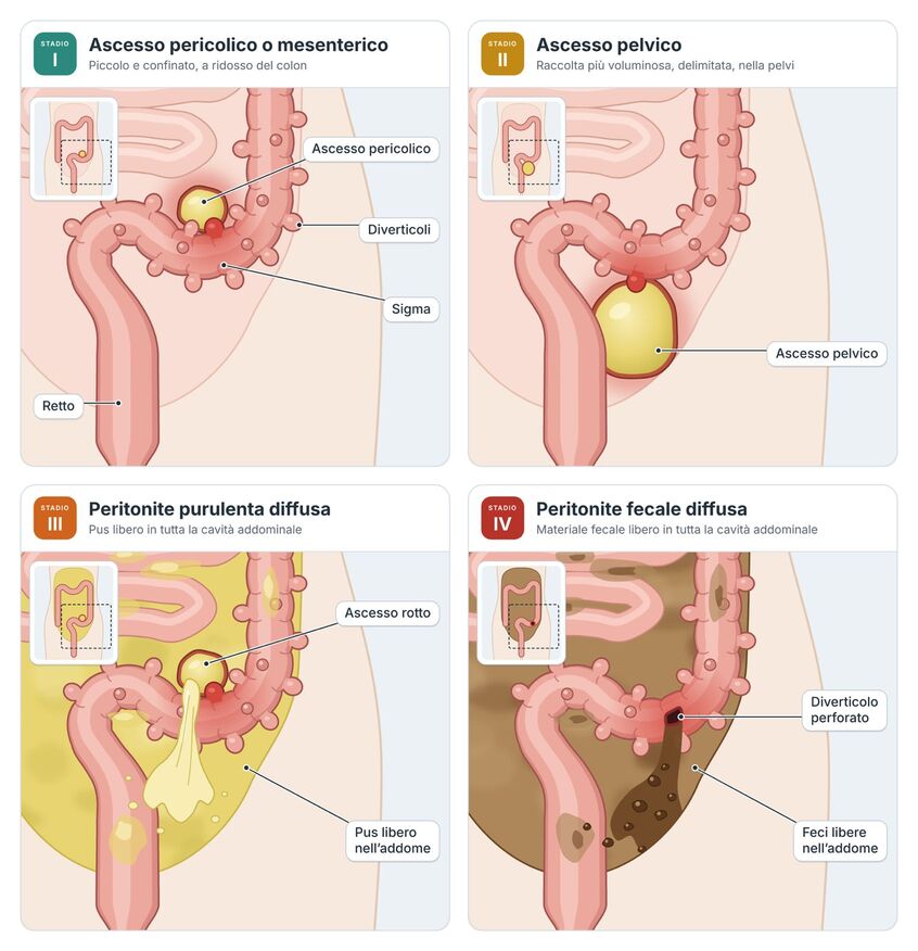 quattro stadi della diverticolite complicata