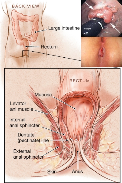 tumore anale diagnosi trattamento