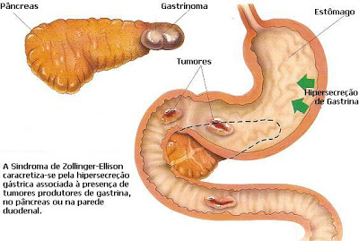 Sindrome di Zollinger-Ellison